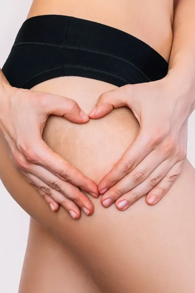 estrias_dermatologia