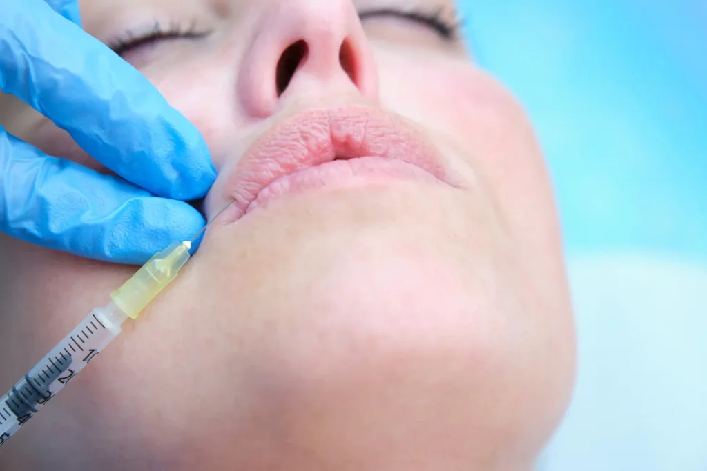 Aplicación de ácido hialurónico en los labios