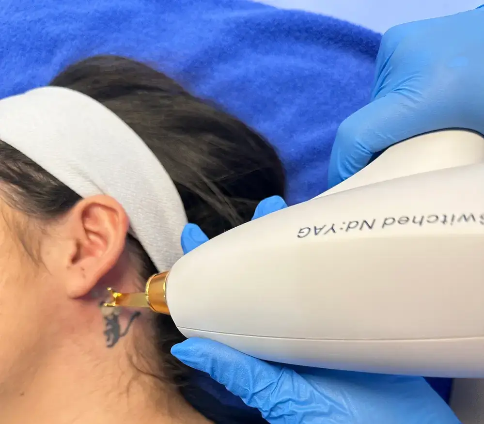 eliminación de tatuajes robótica » Clínica de Dermatología Robótica Detalle del robot Stellar M22 en procedimiento dermatológico
