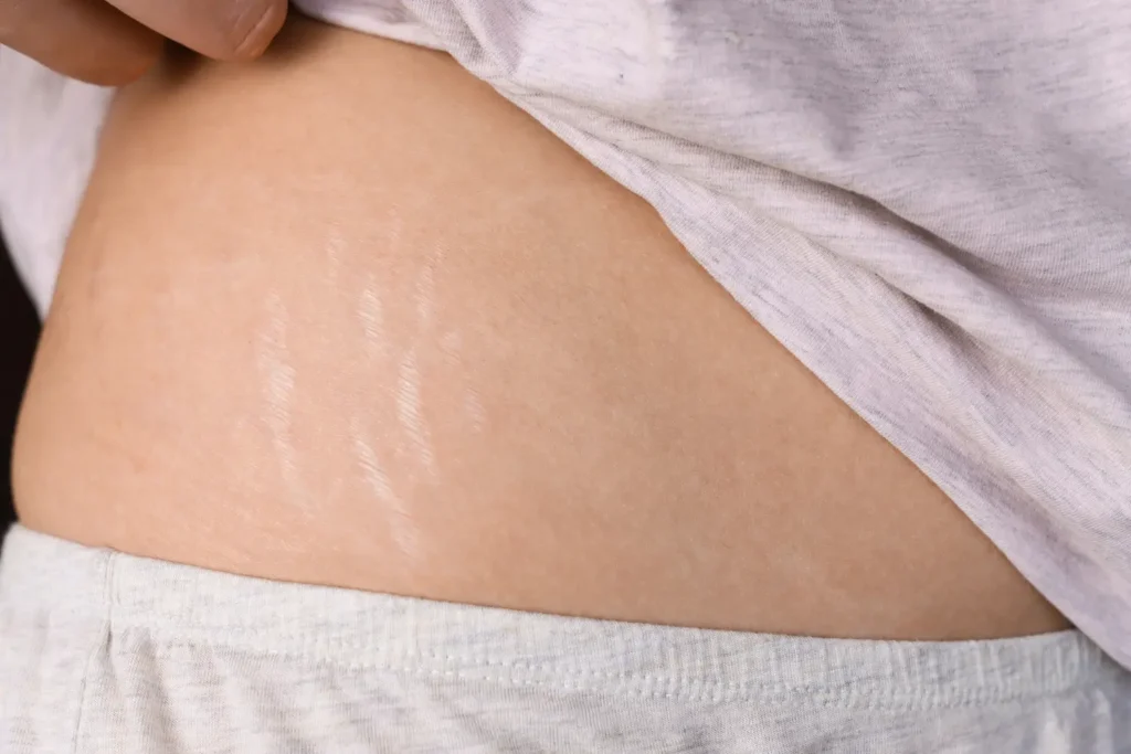 Imagen de abdomen con estrías visibles - estrías del embarazo en el segundo trimestre- clinica de dermatologia robotica