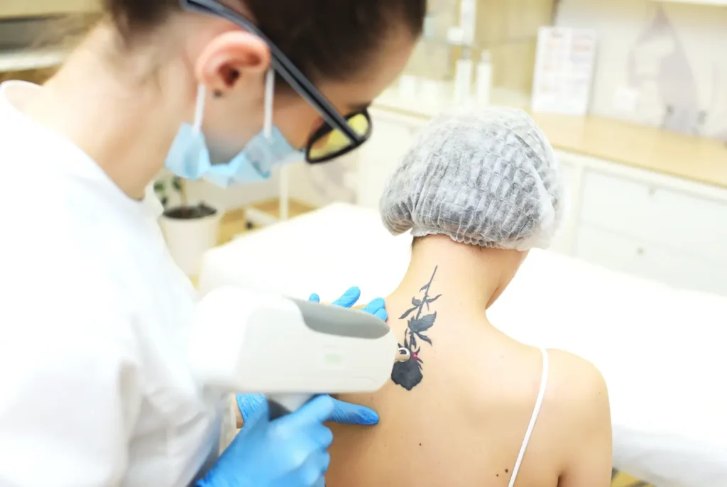 eliminación de tatuajes robótica » Clínica de Dermatología Robótica Paciente recibiendo eliminación de tatuajes robótica con láser- clinica de dermatologia robotica