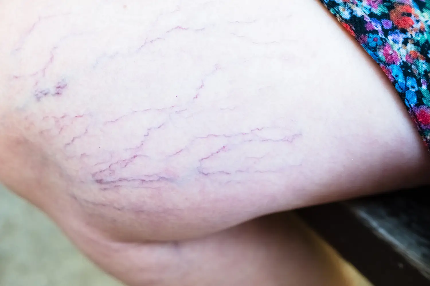 Primer plano de telangiectasias en la pierna de una mujer- clinica de dermalogia robotica