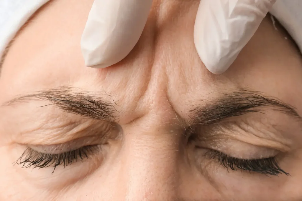 Primer plano del efecto de la toxina botulínica en el entrecejo