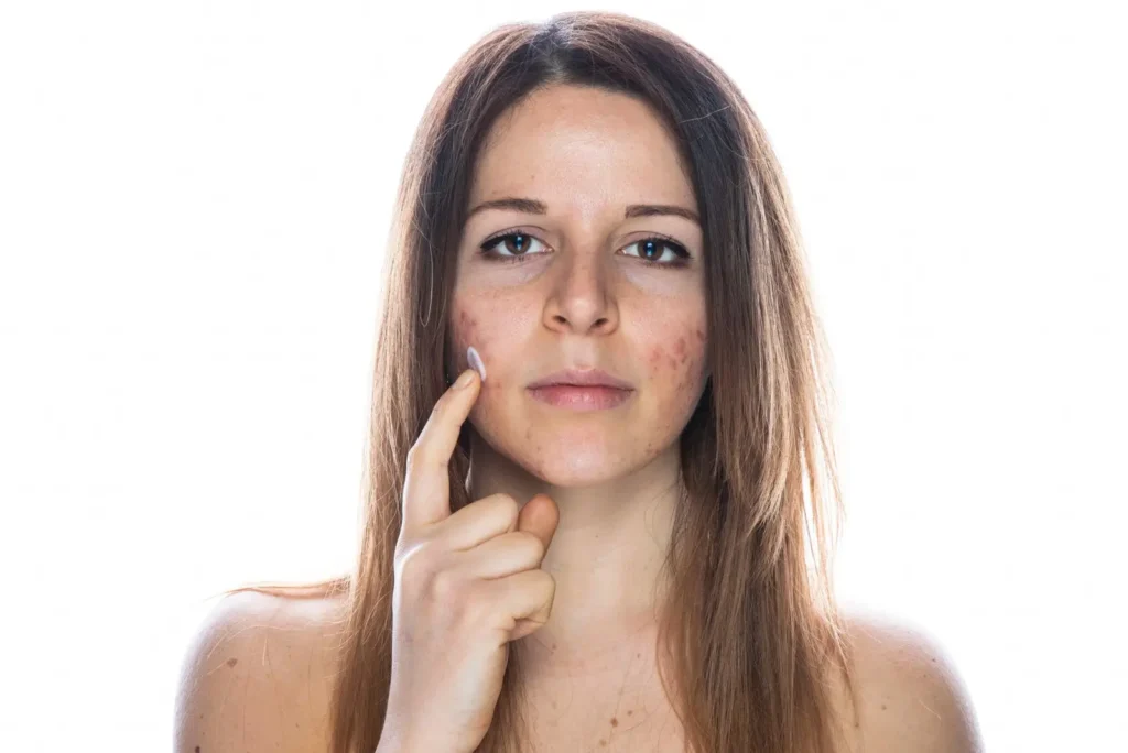 Que-es-el-acne-y-sus-tratamientos-clinica-de-dermatologia-robotica-scaled