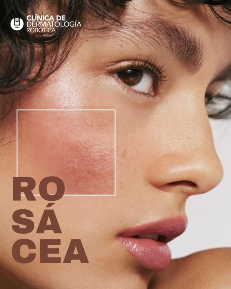 Rosacea en el rostro que es- clinica de dermatologia robotica