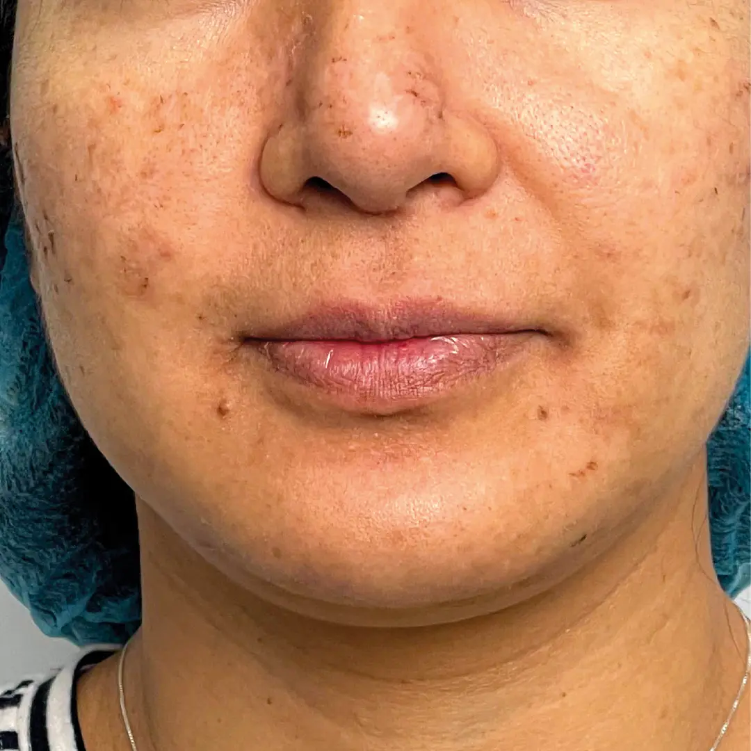 dermatologia acné caso 7 antes-100