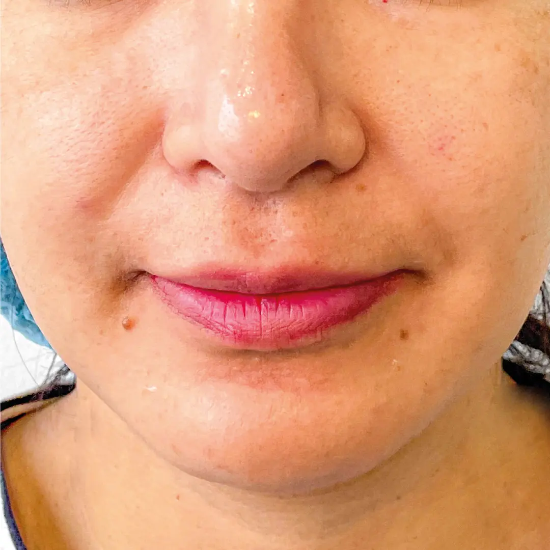dermatologia acné caso 7 despues-100