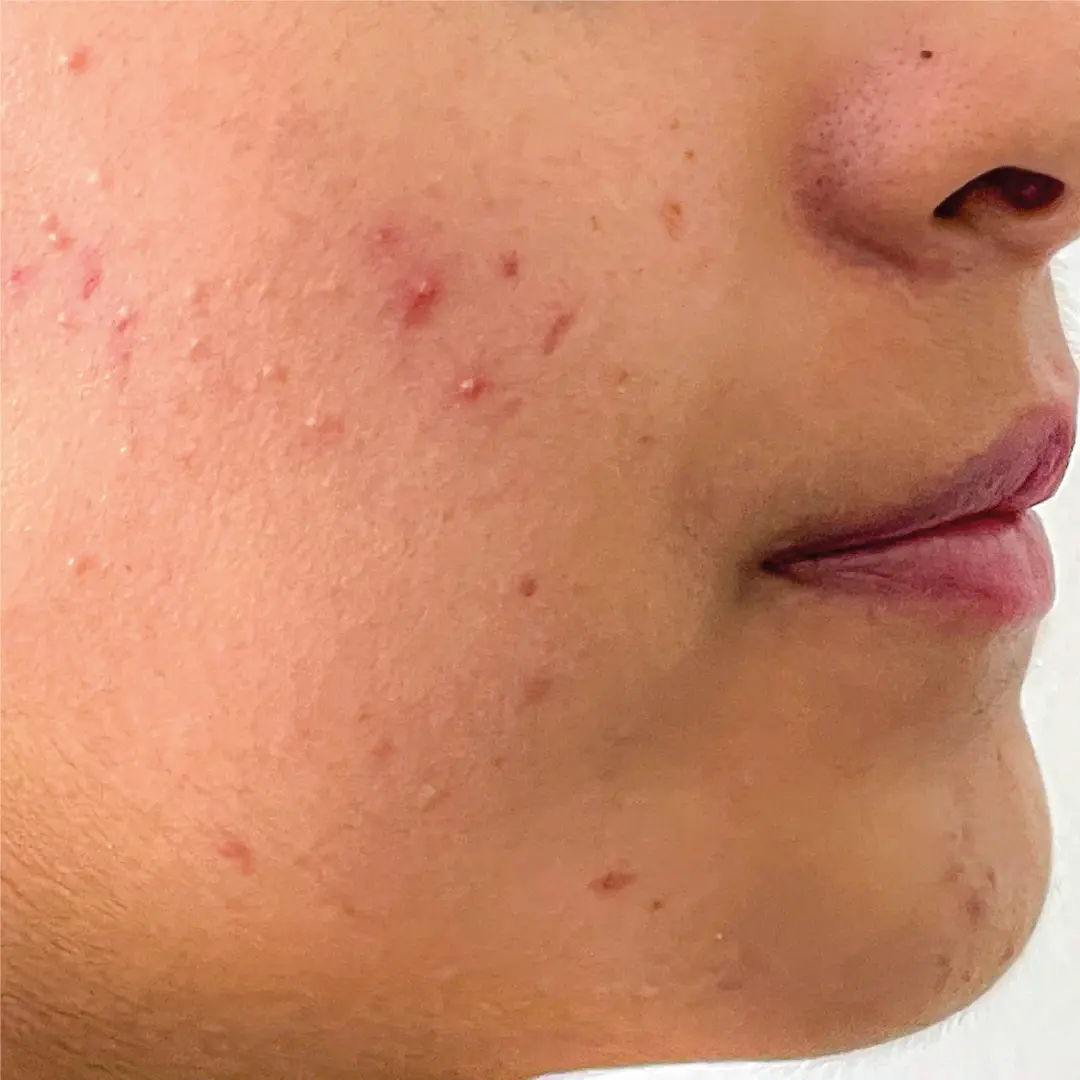 dermatologia acné caso 8 antes-100