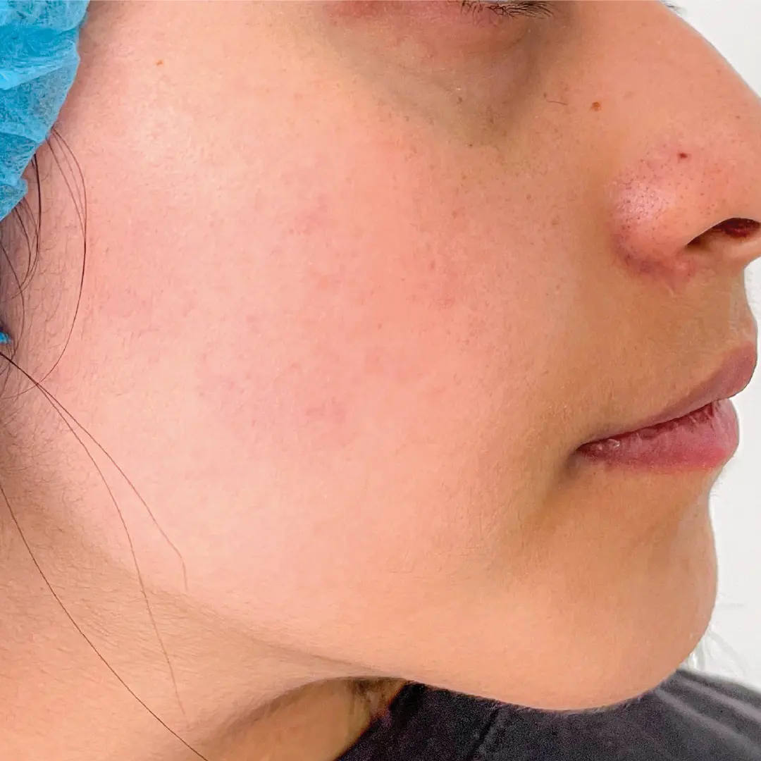 dermatologia acné caso 8 despues-100
