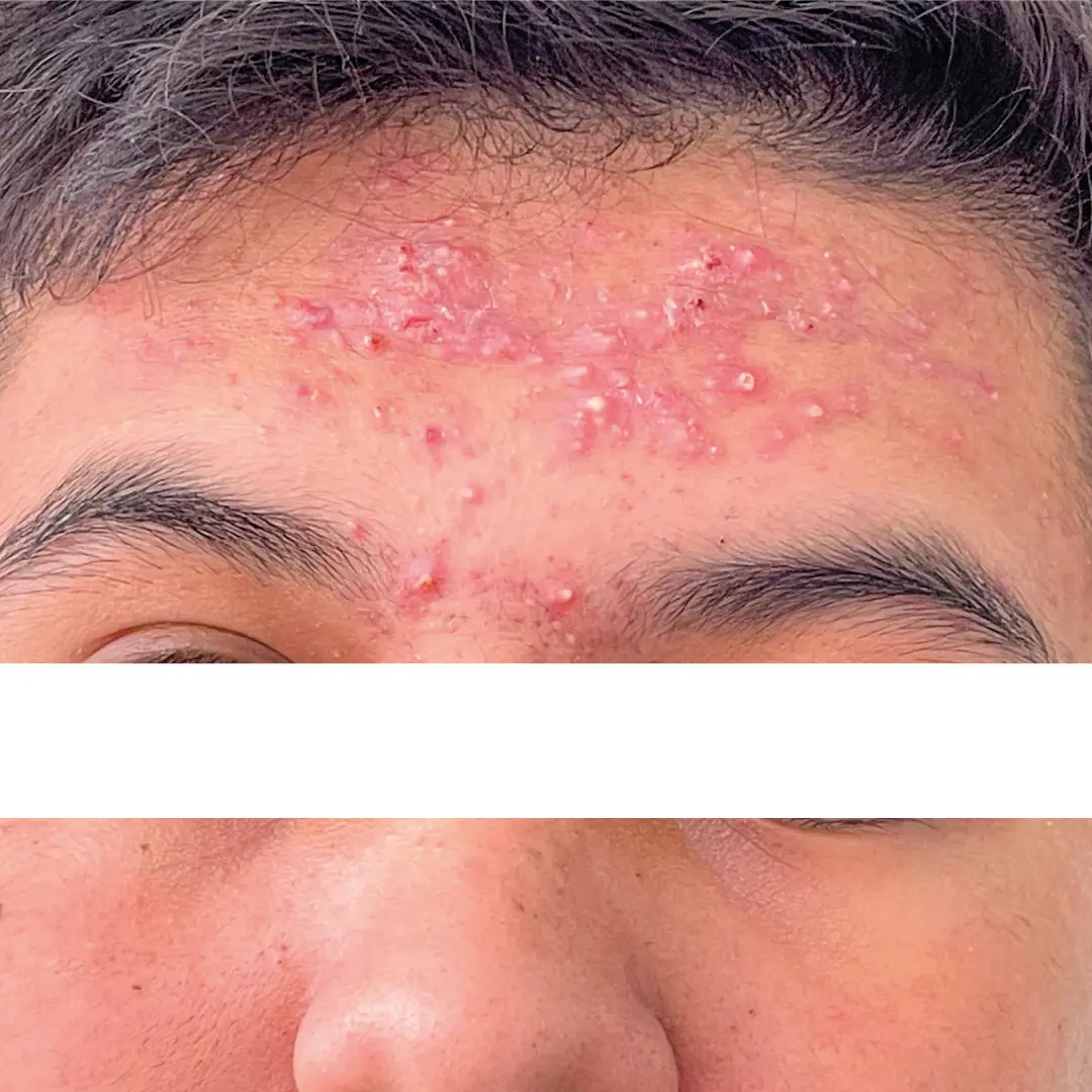 dermatologia acné caso 9 antes-100