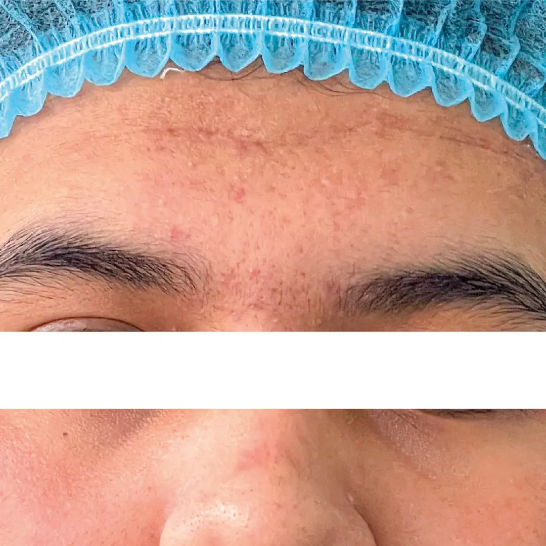 dermatologia acné caso 9 despues-100