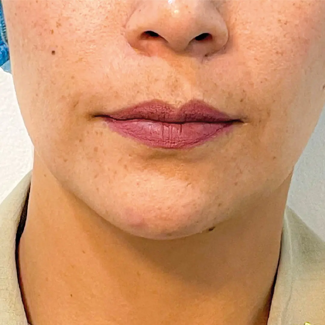 dermatologia efélides caso 10 antes-100 dermatologia efélides caso 10 antes-100