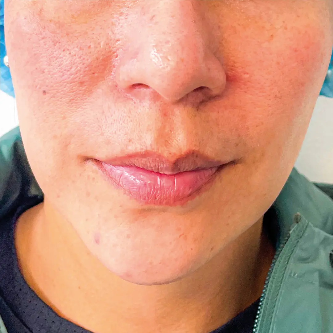dermatologia efélides caso 10 despues-100 dermatologia efélides caso 10 despues-100
