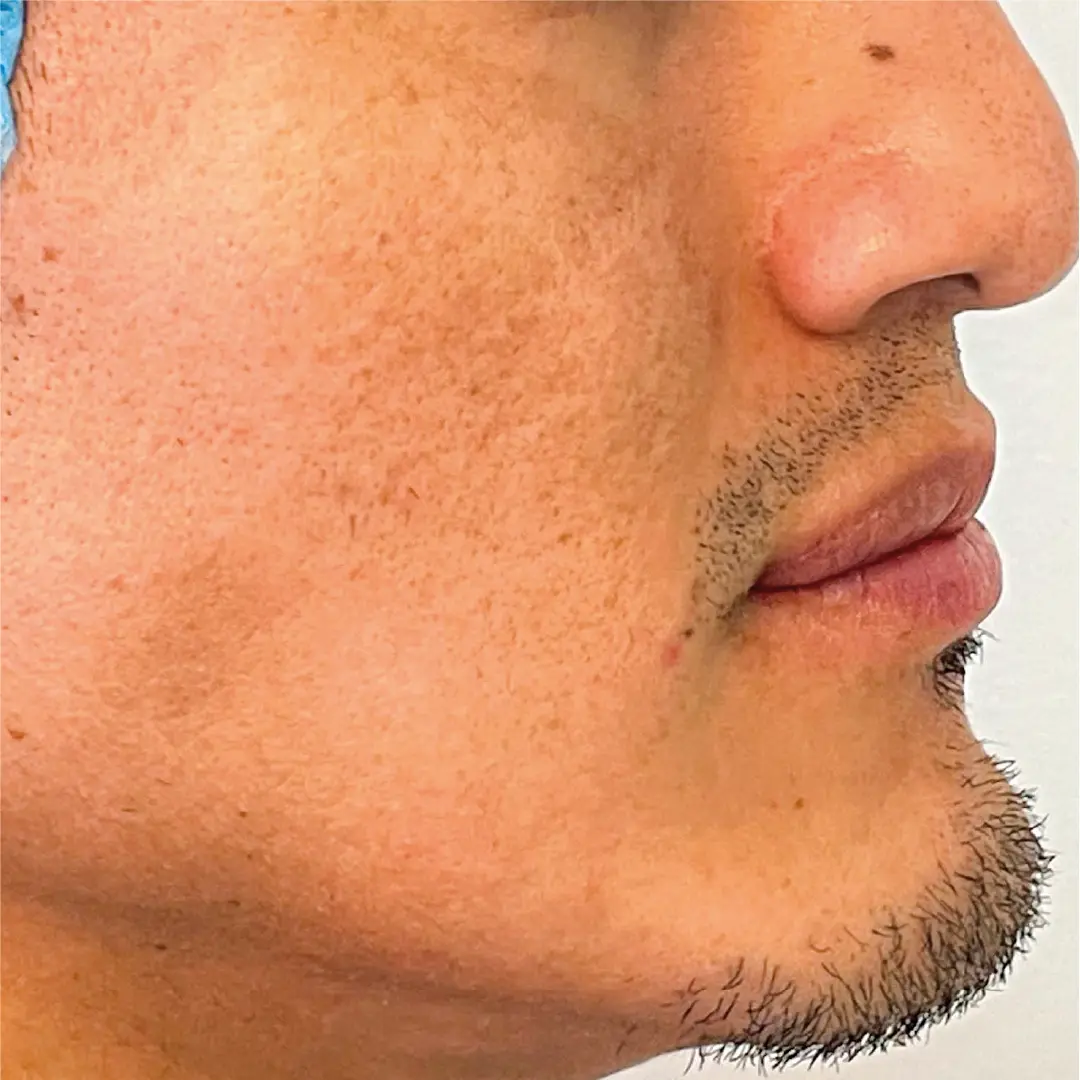 dermatologia melasma caso 5 antes-100 dermatologia melasma caso 5 antes-100