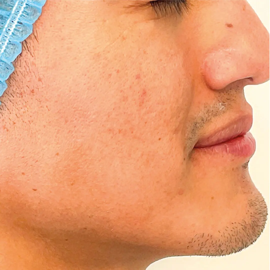 dermatologia melasma caso 5 despues-100 dermatologia melasma caso 5 despues-100
