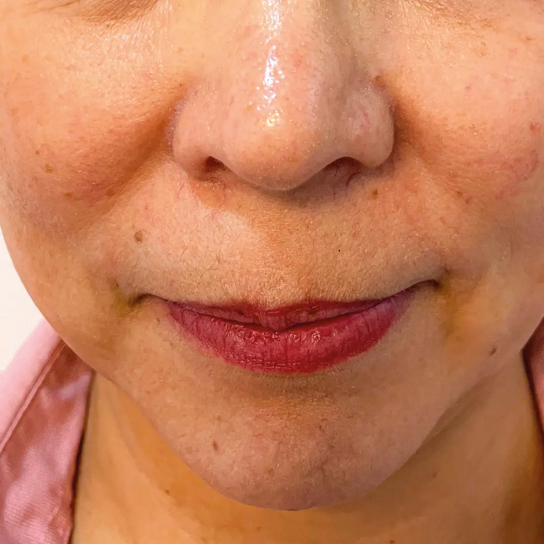 dermatologia melasma caso 6 despues-100 dermatologia melasma caso 6 despues-100
