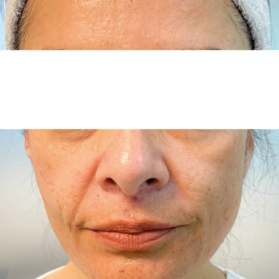 dermatologia rejuvenecimiento facial caso 1 antes-100