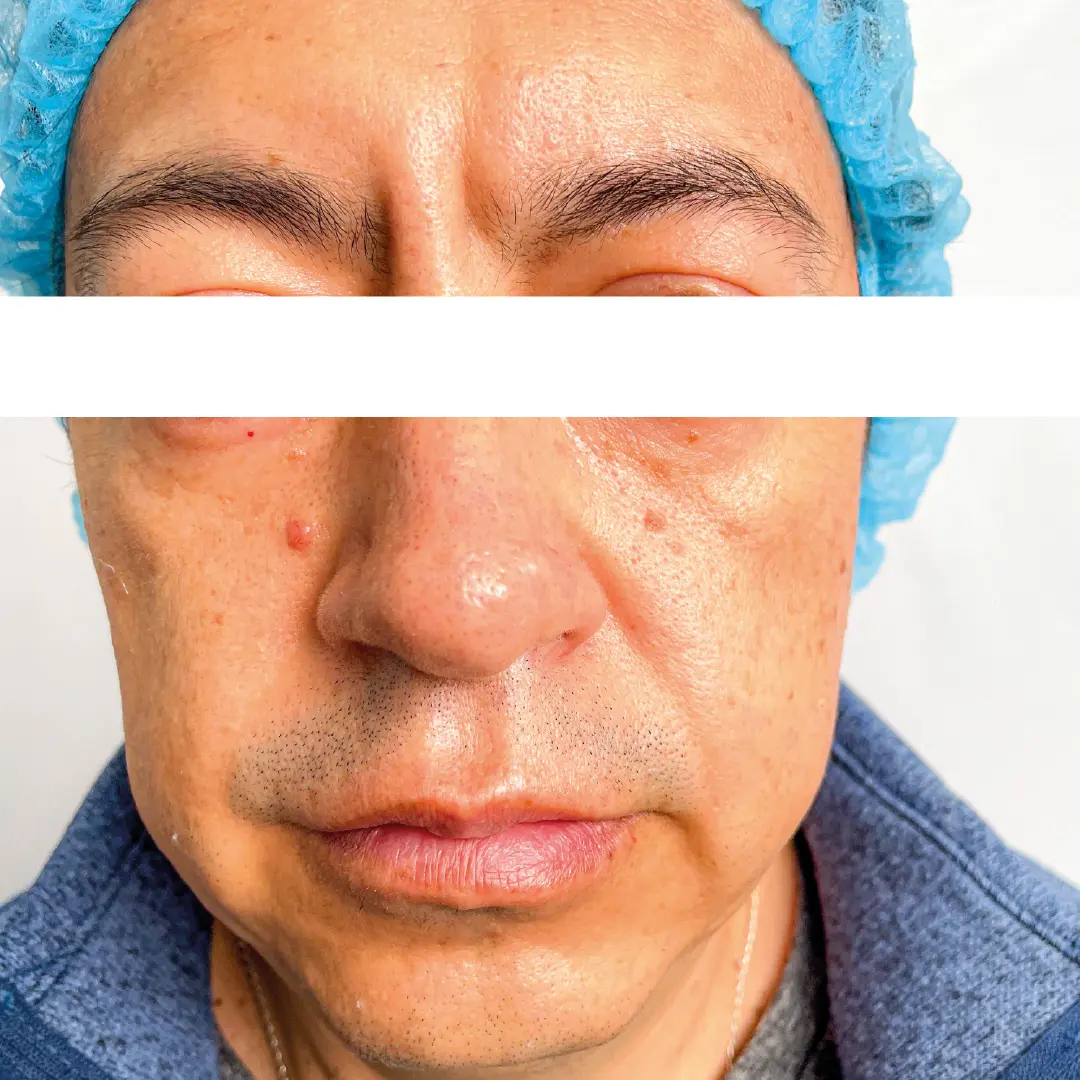dermatologia rejuvenecimiento facial caso 2 antes-100