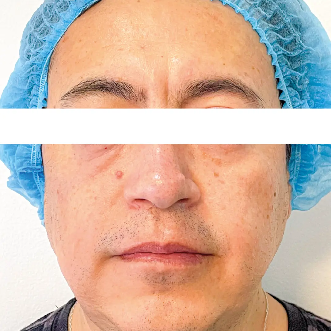 dermatologia rejuvenecimiento facial caso 2 despues-100