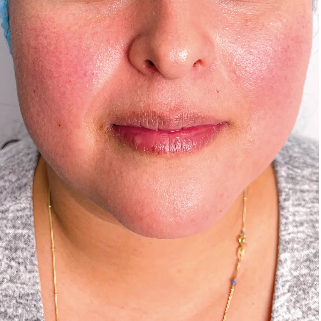 dermatologia rosácea caso 3 antes-100 dermatologia rosácea caso 3 antes-100