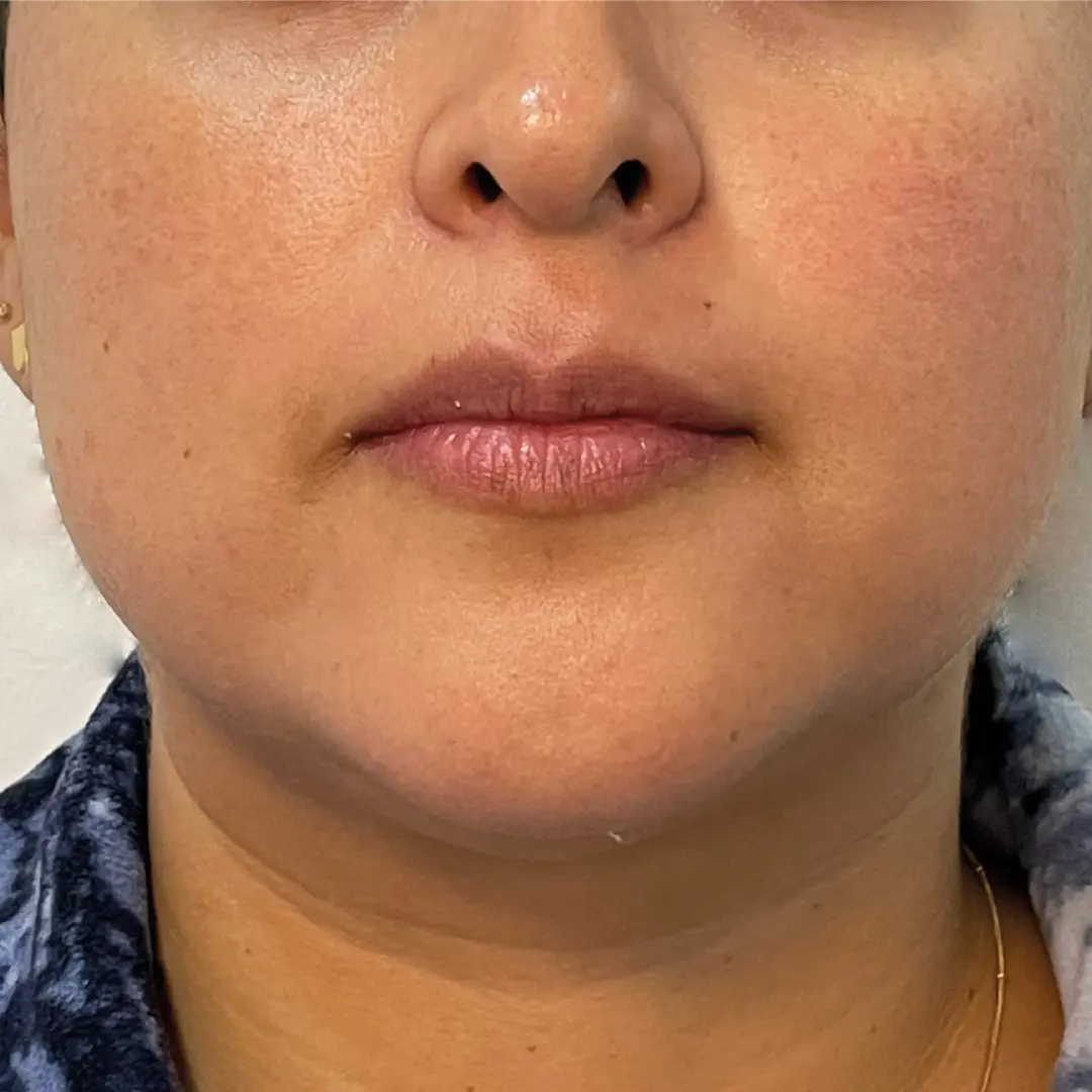 dermatologia rosácea caso 3 despues-100