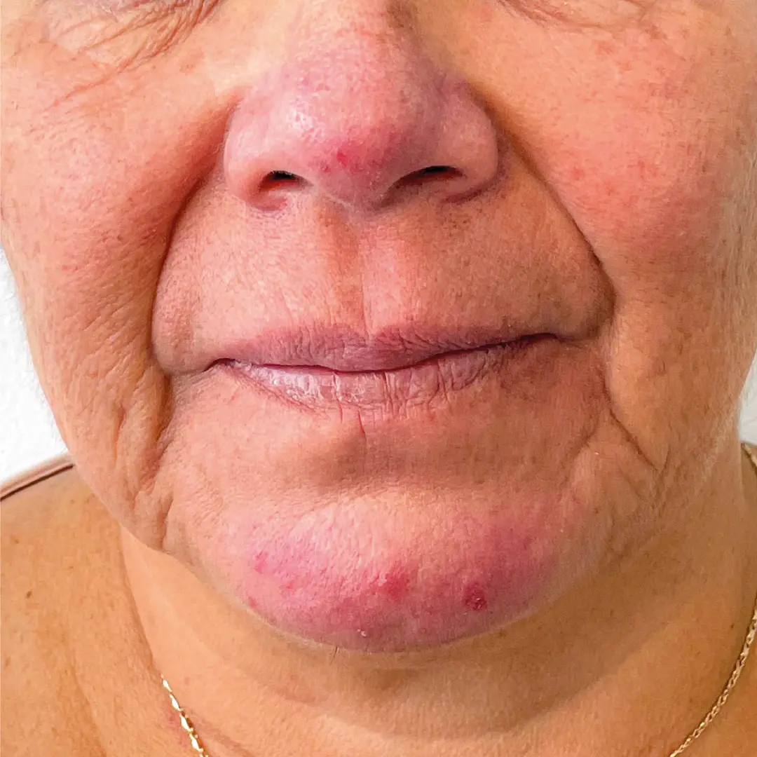 dermatologia rosáceacaso 4 antes-100 dermatologia rosáceacaso 4 antes-100