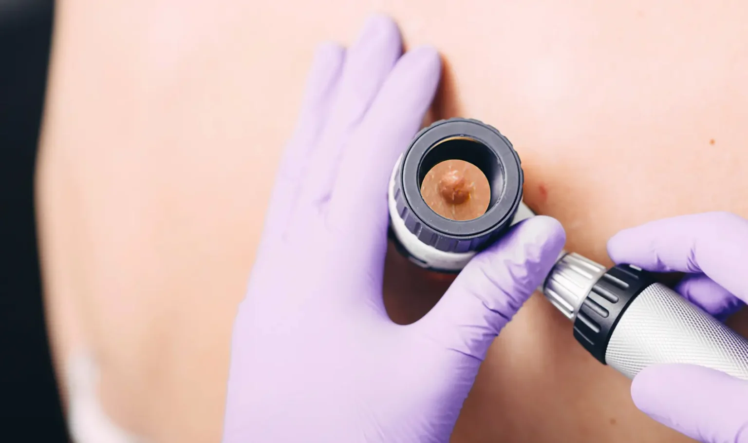 Blog dermatología robótica | Clínica de Dermatología Robótica Dermatoscopio en consulta, evaluando lunares cancerigenos