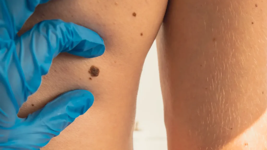 Ilustración explicando qué es melanoma y cómo se origina en los melanocitos