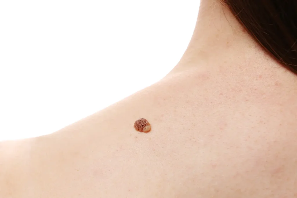 Ilustración explicando qué es melanoma y cómo se origina en los melanocitos2