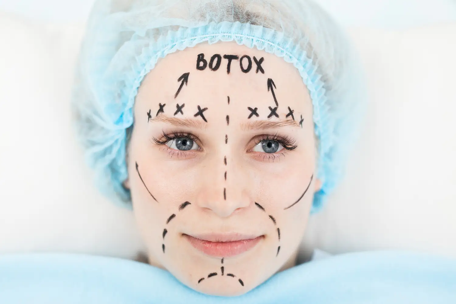 Sesión médica mostrando cómo se aplica el botox en el entrecejo- clínica de dermatología robótica