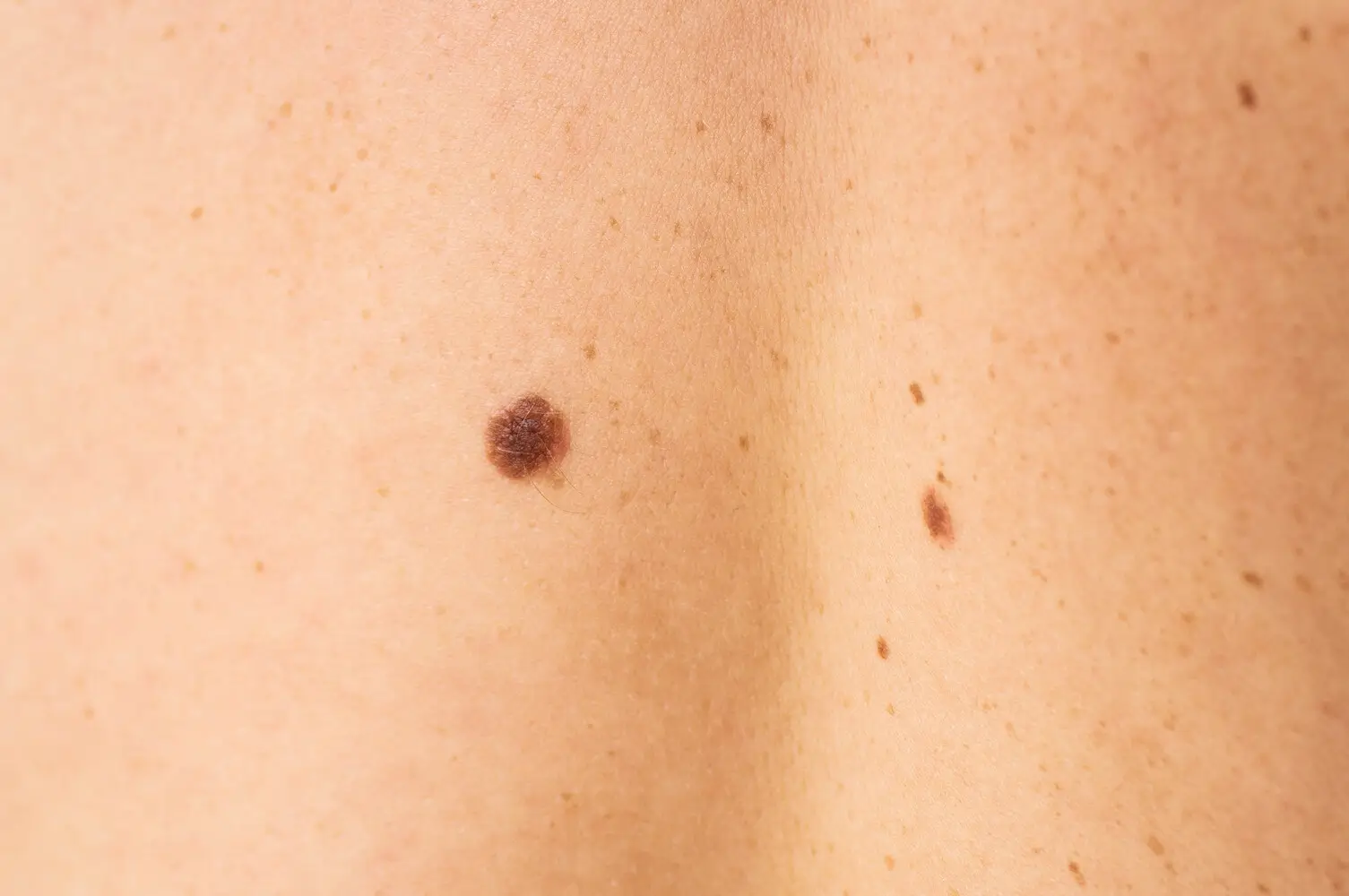 Blog dermatología robótica | Clínica de Dermatología Robótica lunar benigno simétrico con color uniforme para comparar con lunares cancerigenos