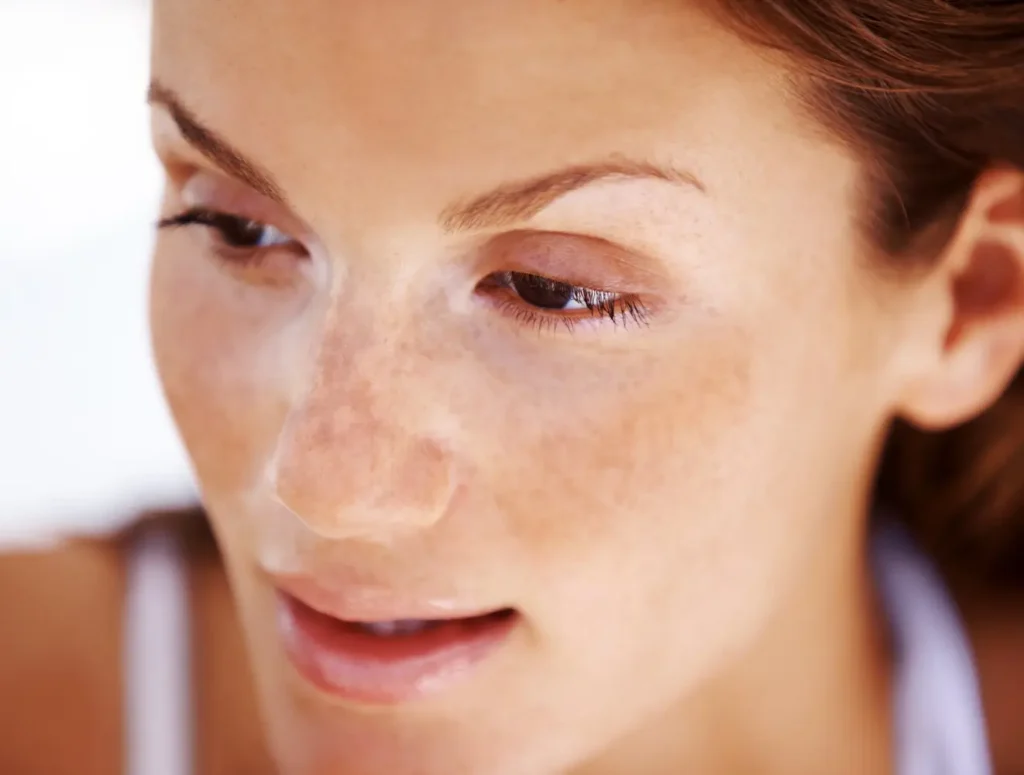 manchas de sol en pómulos tras exposición UV sin protección
