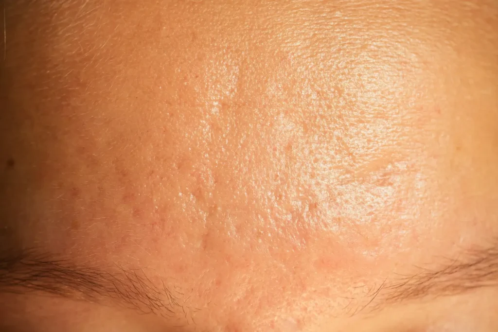 tratamiento para disminuir los poros abiertos cara-clinica de dermatología robótica