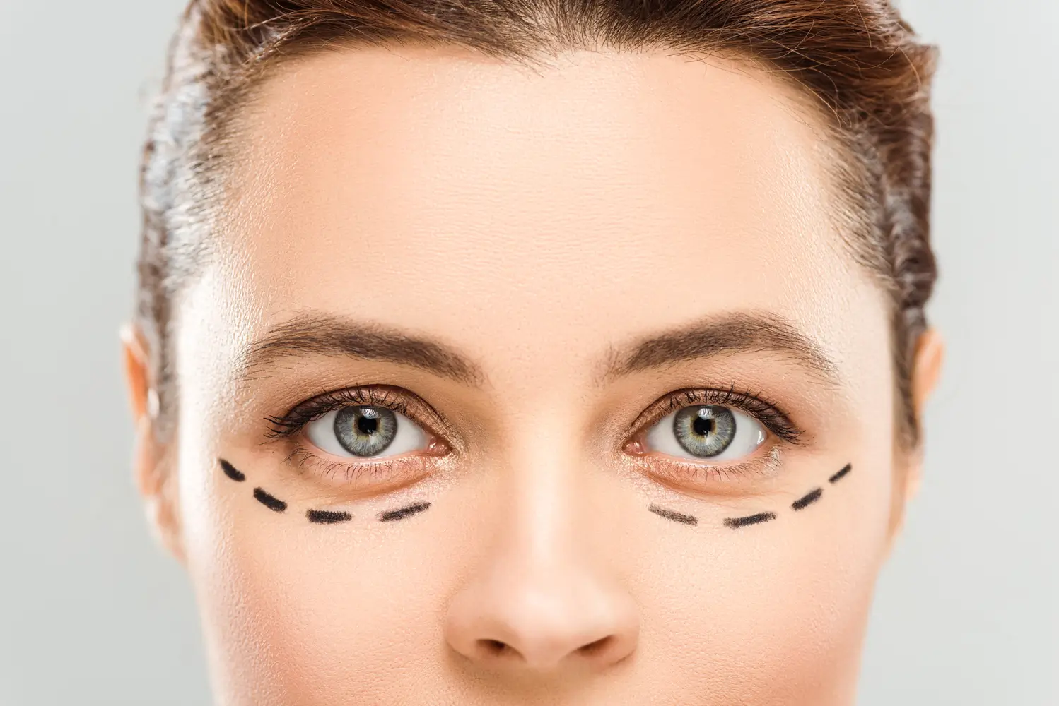 Blog dermatología robótica | Clínica de Dermatología Robótica Comparación antes y después de un tratamiento para las ojeras- clinica de dermatología robótica