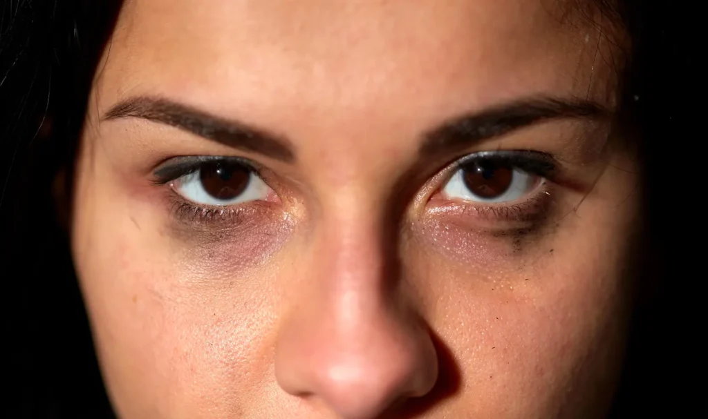 Primer plano de mujer con ojeras visibles antes de tratamiento- clinica de dermatología robótica