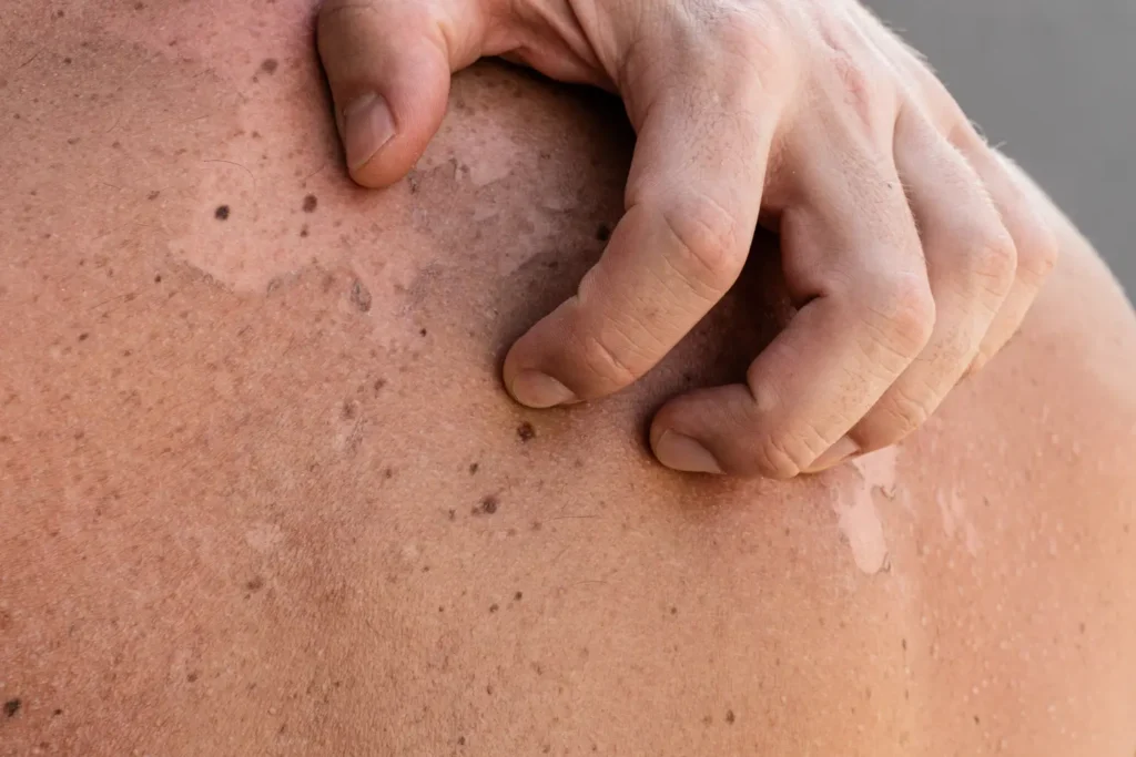 manchas negras en la piel | Clínica de Dermatología Robótica manchas en la piel - clinica de dermatología robótica