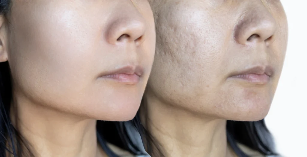 Antes y después del ácido hialurónico para eliminar manchas - clinica de dermatologia robótica