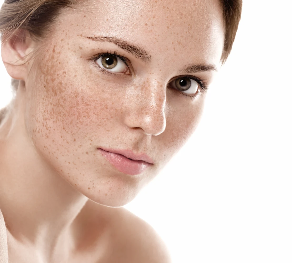 Zonas del rostro afectadas por melasma – que es un melasma facial - clinica de dermatologia robótica