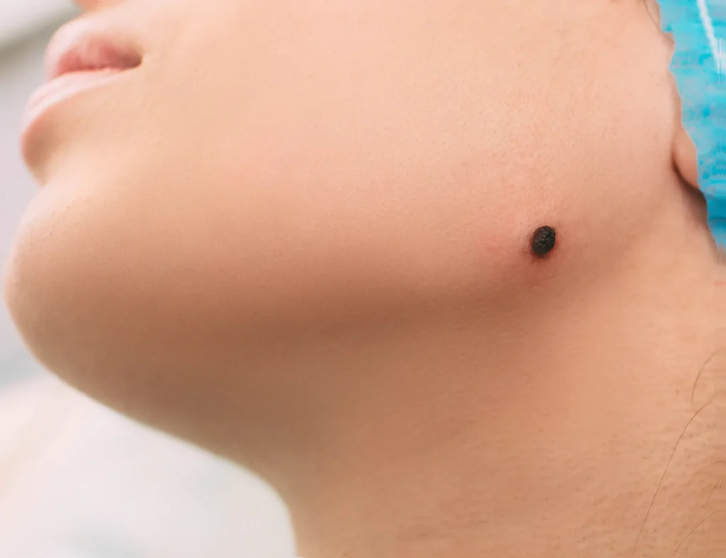 la regla ABCDE de lunares cancerígenos - clinica de dermatologia robotica