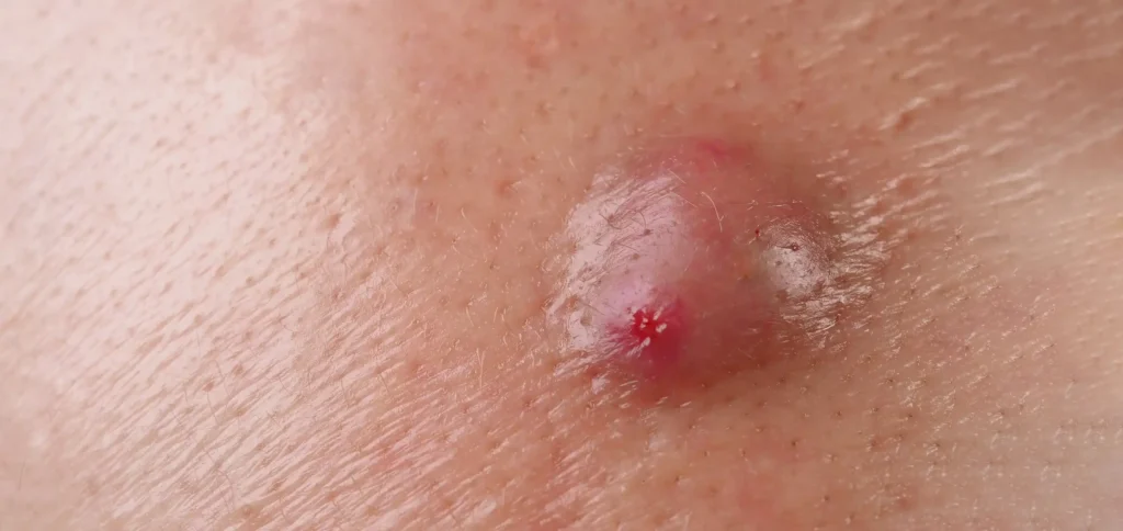 tipos de úlceras en la piel en tabla clínica - clinica de sobrepeso obesidad y metabolismo