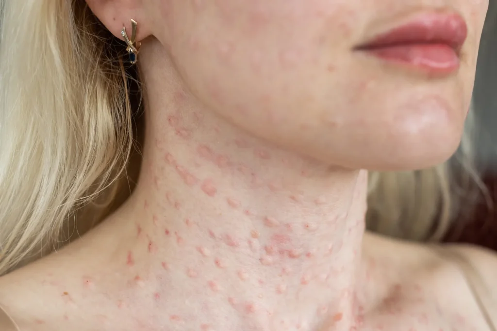 Primer plano de papulas en la piel en rostro - clinica de dermatologia robotica