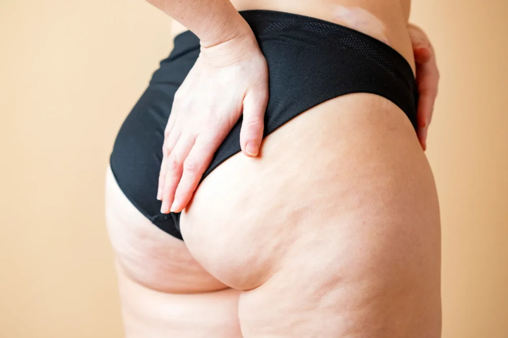 tratamiento anticelulitis Quito - clinica de dermatologia quito
